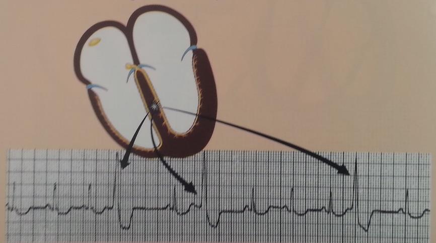 PVC ise çıktığı ventrikülü diğerinden daha erken uyarır daha derin yüksek (zıt yöndeki uyarılar eşzamanlı olmadığı için) ve daha geniş bir QRS kompleksi ortaya çıkar. 1.4.