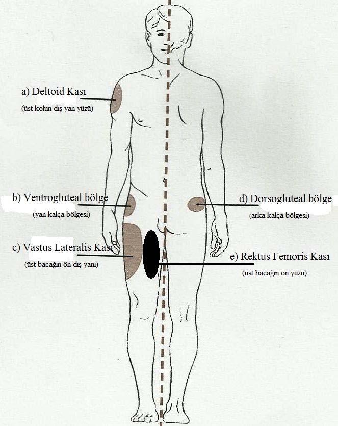 3- Bölgesi ve komplikasyon türünü (ağrı, dokuda sertleşme, kızarıklık, abse, doku nekrozu, hematom, damar yaralanması, sinir yaralanması,) yazar mısınız?