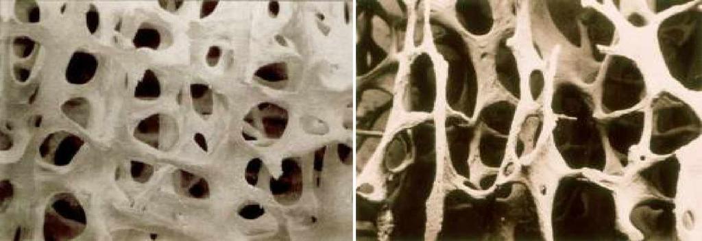 Osteopetrozis Osteoklastik kemik rezorpsiyonunda yetersizlik ile karakterizedir. Çe itli tipleri vard r. Serum kalsiyum, fosfor, alkalen fosfataz düzeyi normaldir.