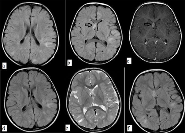 displazi) (7, 8). Bu anomaliler genellikle epileptojeniktir ve tedaviye dirençli epilepsiye yol açabilirler (9).