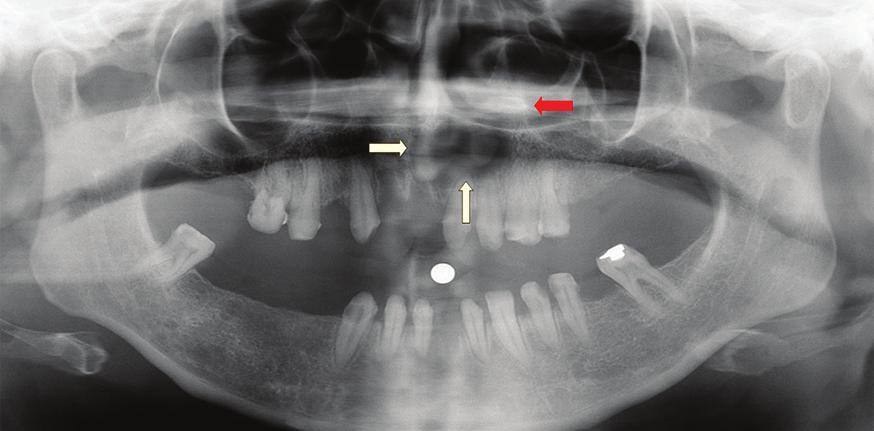 zamanlarını da belirlemek mümkün değildir. Çünkü belirlenene kadar uzun bir süre asemptomatik olarak kalmış olabilirler. 1,5 Tanısı, klinik ve radyografik inceleme ile konur.