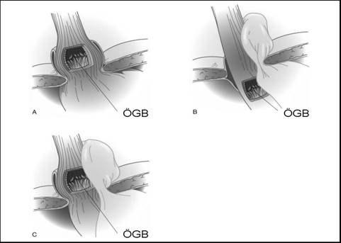 11 Şekil 3. Hiatal Herni A) Tip I, B) Tip II, C) Tip III hiatal herni.