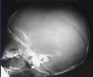 trauma (pedestrian struck by motor vehicle, occupant ejected from motor vehicle, fall from height >3 feet or 5 stairs) BT endikasyonları LOC < 15 GCS Focal neurologic sign Clinical sign of skull