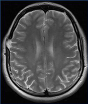 Depressed- Kranium kemik kalınlığından fazla depresyon operasyon Yenidoğan ve infantlarda depressed frx-ping pong frx Diastatic-sütur seperasyonu Depressed, basilar- leptomeningial kist (growing frx)