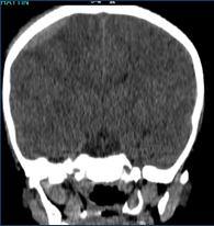 Anterior ethmoid arter Dural sinüs zedelenmesi