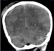 İnfantlarda kırık olmadan epidural hematom