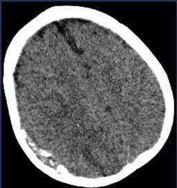 konfüzyon Blood-Brain-Barrier olmadığı