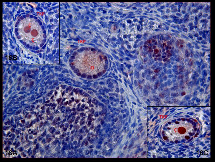 Resim 16A,B,C: Klomifen sitrat uygulaması yapılan gruba ait gebe ovaryumlarında PCNA immünreaktivitesinin özellikle çekirdek düzeyinde belirgin olduğu görülürken,