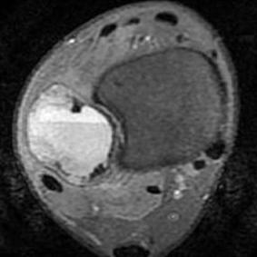 görüntülerde multilokule lezyon içinde sıvı- sıvı seviyesi, kortikal incelme ve endosteal kortekste çanaklaşma, (F) Postkontrast T1- SE Y sagital görüntüde lezyon içinde ince septal