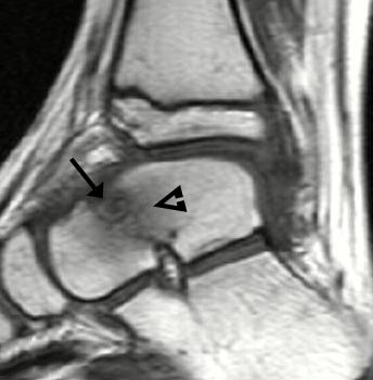 lt Ekstremite Tümörleri 519 C Resim 2. -D. Osteoid osteoma.