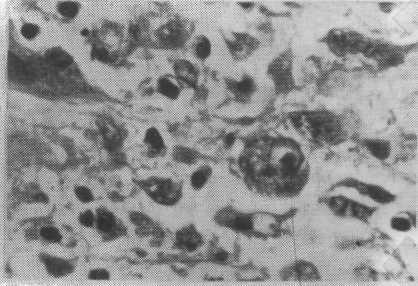 Resim. Çıkarılan kolon kısmının makroskopik görüntüsü (Olgu No: 1) Resim 1 ve 2. CMV pnömosinin radyolojik ve bilgisayarlı tomografideki görüntüsü (Olgu No:) Resim.