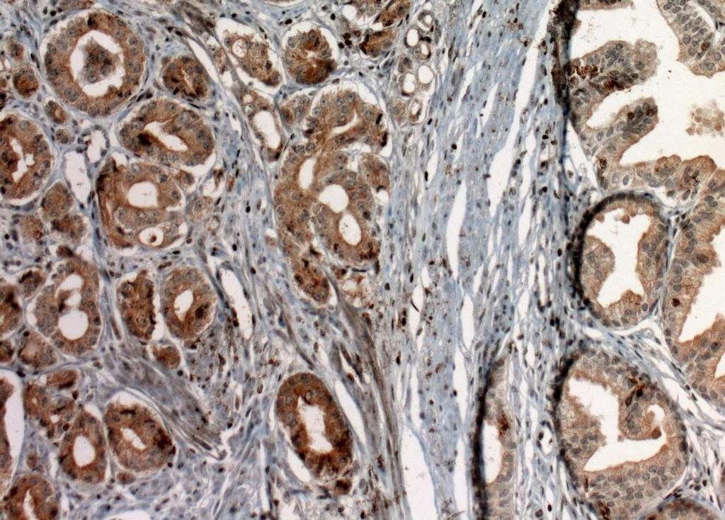 (x200) Resim 4: Karsinom odağı ve benign prostat dokusunda