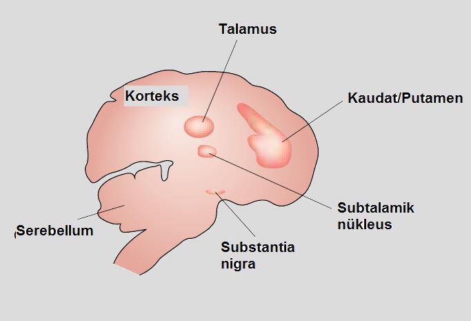 Şekil 1: Huntington hastalığında majör nöronal kaybın gözlendiği beyin bölgeleri 36 Magnetik rezonans görüntüleme ile, hastalığın orta yaşlarda başlayan hiperkinetik formunda, T 2- ağırlıklı MR