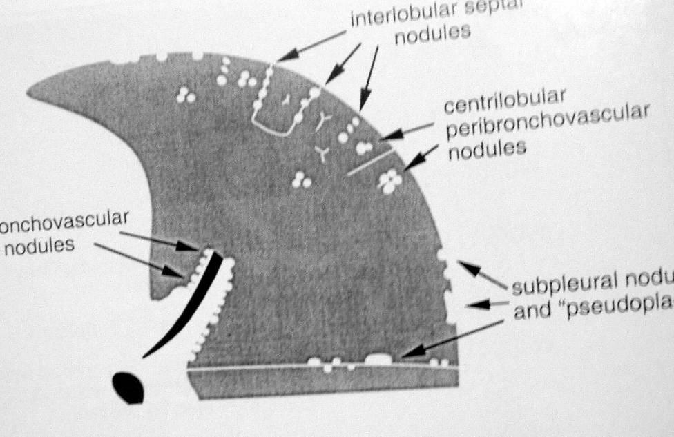 Perilenfatik nodüller Peribronkovasküler İnterlobüler septal Sentrlobüler interstisyum Subplevral