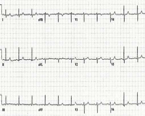 V1 de Yeni Yüksek T Dalgası Normal EKG de V1 in T dalgası düz ya da negatif Pozitif ise anormal: