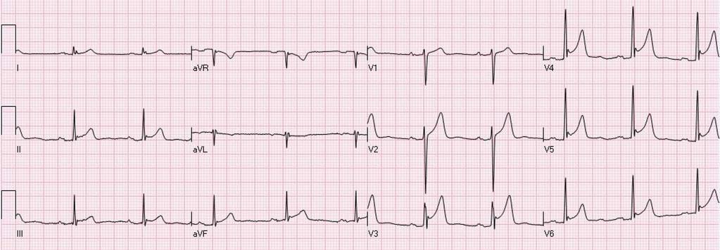 Benign Erken Repolarizasyon (BER) J nokta elevasyonu T dalgası sivrileşmiş ve hafif asimetriktir.