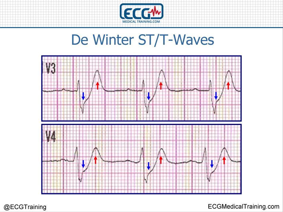 De Winter s Dalgaları EKG Prekordiyal derivasyonlarda yüksek, çıkıntılı, simetrik T dalgaları.