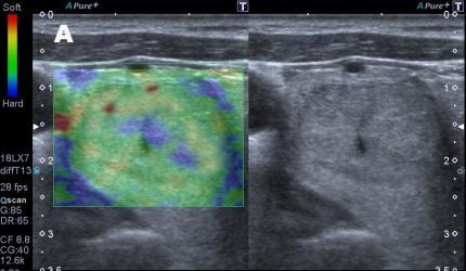 Resim 1. 5 hastada, tiroid nodüllerinin elastogram (sol) ve gri skala (sağ) görüntüleri. A. Foliküler adenom, Skor 1, 56 yaşında kadın hasta. B. Foliküler adenom, Skor 2, 39 yaşında kadın hasta. C.