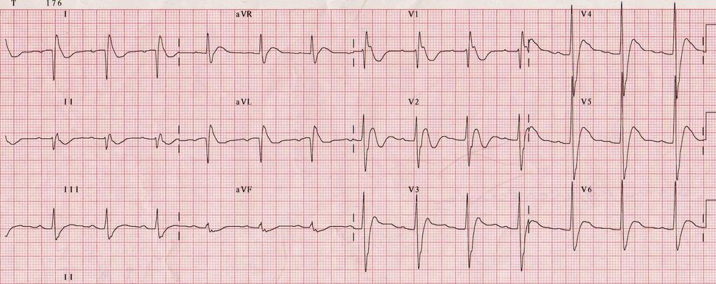 EKG Kısa QT Osborn dalgaları (J dalgaları) ST-T değ Kısa