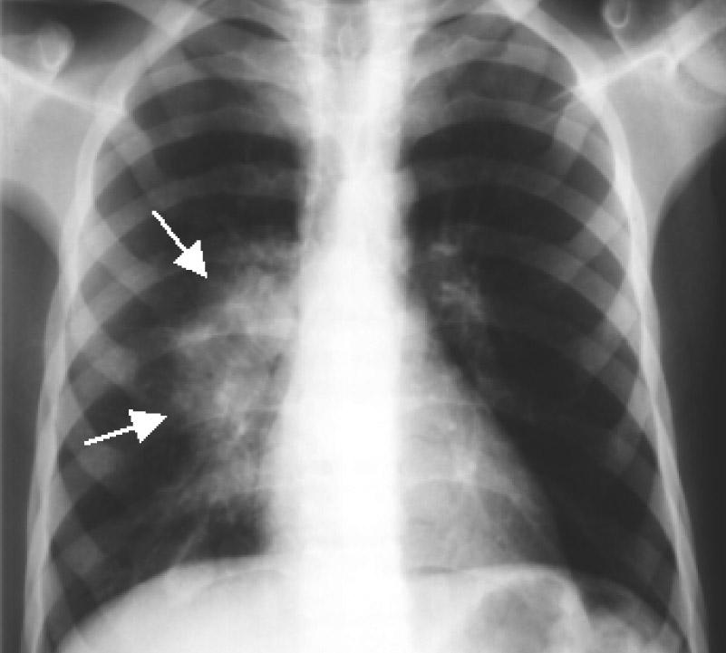 Bronfllar n ekstrinsik kompresyondan daha fazla etkilenmeleri nedeniyle 2 yafl ndan küçük çocuklarda s k görülür (13).