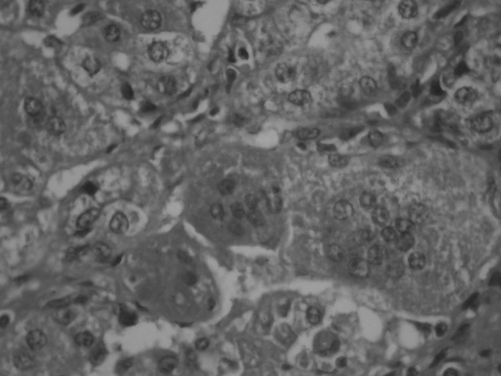 H. Tosun Yıldırım ve ark., Neonatal kolestazda histopatolojik ayırıcı tanı daha küçük, 10 u (%43,4) 3 aylıktan büyüktü.