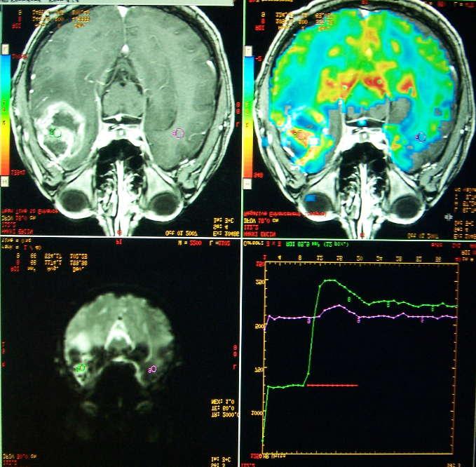 A A D B C Şekil 4.5. Glioblastoma multiforme olgusu (GBM). 54 yaşında erkek hasta. A. Aksiyel EPI-GRE görüntüde sağ temporal lobda hiperintens sinyal özelliğinde kitle lezyon izlenmektedir. B. Aksiyel kontrastlı T1 A görüntüsünde çevresel ödem alanın ve santralinde nekroza ait hipointens sinyal değişikliğin eşlik ettiği periferal kontrastlanan kitle lezyonu izlenmektedir.