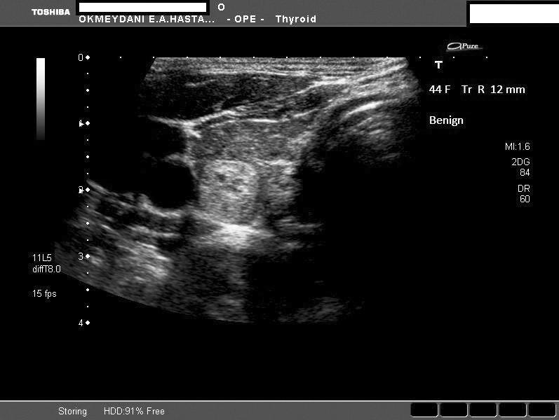 Ö. Özer ve ark., Tiroid Nodüllerinde Ultrasonografi ile Malignite Kriterlerinin Değerlendirilmesi Tablo 3.