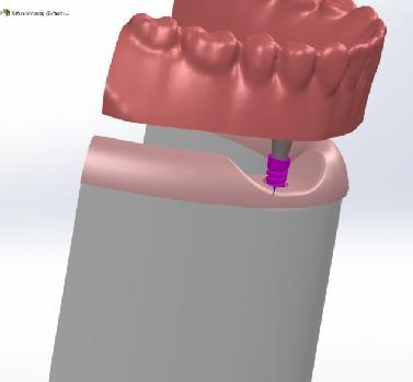 Şekil 1 de abutment ve abutmentlara uygun ara bağlantı elemanlarının tasarım şekilleri verilirken Şekil 2 de ise, hasarsız alt çene kemiği için geliştirilen implant modelinin tasarım şekli ve katı