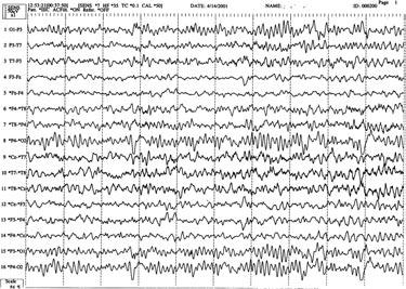 40 Epilepsi Cilt 7, Say 1-2, 2001 Göz kapatma ile ortaya ç kan epileptiform deflarjlar n, gözler kapal iken ortaya ç kan epileptiform deflarjlardan ayr lmas gerekir.