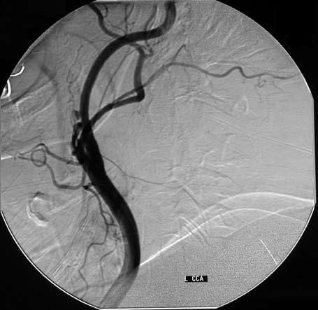 (a) (b) Şekil 2. (a) Sol ana karotis arter anjiyografisinde medial duvarda dolum fazlalığı ve duvarda düzensizlik şeklinde izlenen psödoanevrizma görülmekte.