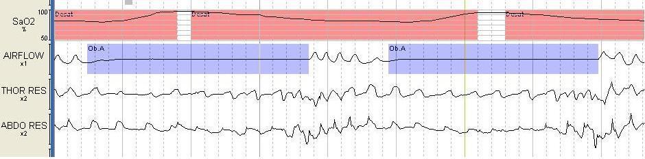 c. Uyku ile ilişkili hipoventilasyon sendromları d. Uyku ile ilişkili hipoksemi sendromu e. İzole semptom ve varyantlar i. Horlama ii.