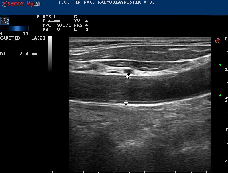 Şekil 7. Radyoterapi alan tarafta ana karotis arter çapı: 8.