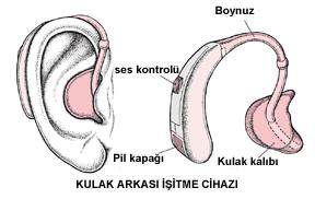 - Baş Bandıyla Kullanılan Cep Tipi 29 İmplante Edilebilir İşitme Cihazları - Kemiğe İmplante Edilebilir İşitme Cihazları - Koklear İmplant 30 2.4.1.