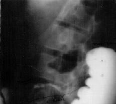 Kartal E itim ve Araflt rma Hastanesi T p Dergisi Crohn hastal kendili inden düzelmeler ve akut alevlenmeler gösteren, gastrointestinal sistemin ilerleyici granülomatöz enflamatuvar bir hastal