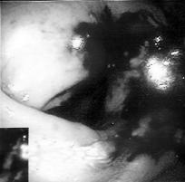 Crohn Hastal na Ba l Enterokutan Fistüllü Üç Olgunun Analizi tan lar ile yo un bak m flartlar nda kaybedildi. fiekil II. Olgunun kolonoskopisinde 37. cm de sirküler darl k ve kanamal alan (olgu 1).