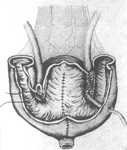 İleal segmentin detübülarizasyonu Resim 3. Üreterler için tünel oluşturulması BULGULAR Hastaların ortalama takip süreleri 13 aydır. Operatif mortaliteye rastlanmamış, postoperatif dönemde 1 hasta 24.