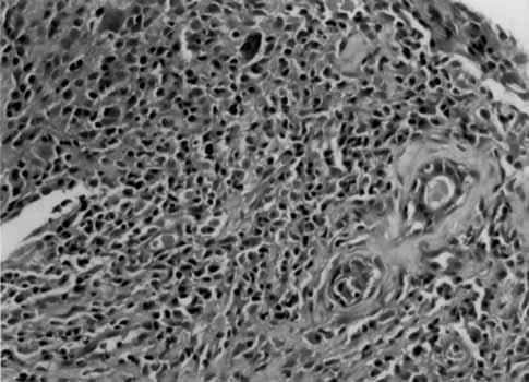 (a) (b) Bafl-boyun bölgesi malign tümörlerinin %5 ini, tüm tükürük bezi kitlelerinin ise %0.06-%5 ini lenfomalar oluflturur.