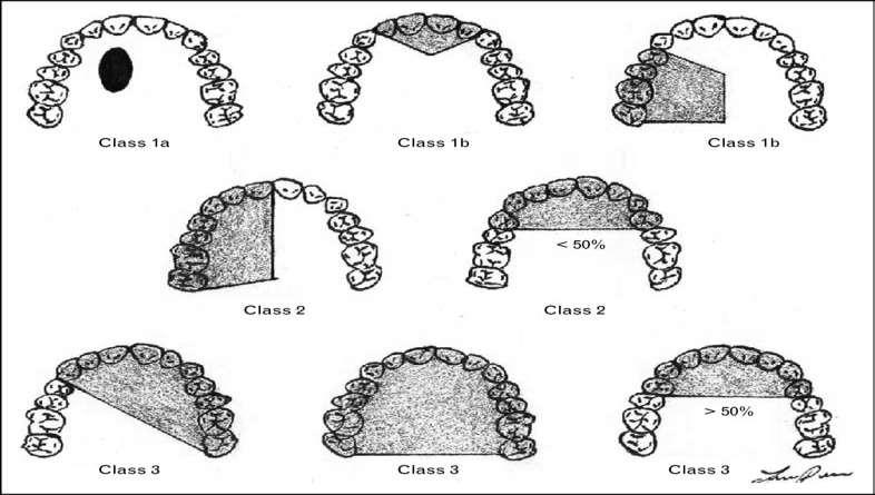 8 kalan dentisyondaki dişlerin kök formu ve kanin dişi protetik prognoz ve destekde önemli rol oynar. Şekil 2.3. Okay ve arkadaşlarının maksillektomi sınıflandırma şeması ayırmıştır.