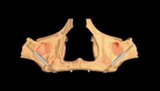 18 Şekil 2.6. Zigomatik implantın görünümü Aparicio ve diğerleri [33] zigomatik kemiğe dental implantların yerleştirilmesi üzerine çalışmışlardır.