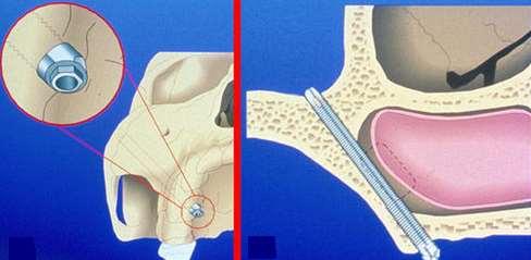 19 Şekil 2.8. Zigomatik implant ve açılı baş kısmı 2.5.1. Zigomatik implantların endikasyonları [35,36,37] Geleneksel implantların yerleştirilmesi için posteriordan kanin bölgesine kadar 4 mm daha