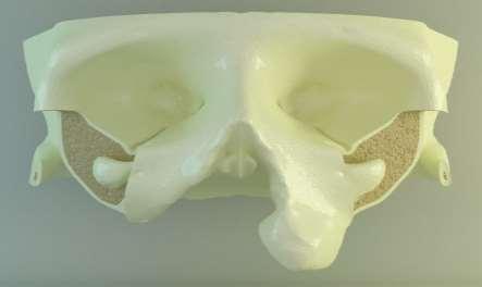 Model elde ederken, kortikal kemik içerisinde kalan bölgelere spongiyoz kemik özellikleri kazandırılarak, tüm arayüz boyunca sıkı bir