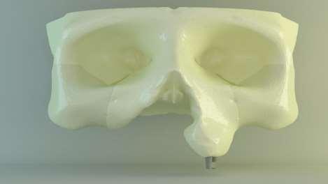 55 Şekil 3.17. Model 4 sadece sağlam tarafa yerleştirilmiş iki adet dental implantdan destek alan locator lı model.