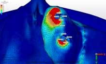 premolar diş hizasına yerleştirilen dental implantın palatinal bölgesi ile defekt tarafına yerleştirilen zigomatik implantın