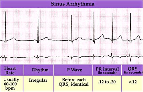 Sinüs aritmisi Solunuma bağlı olarak kalp hızında inspiryumla