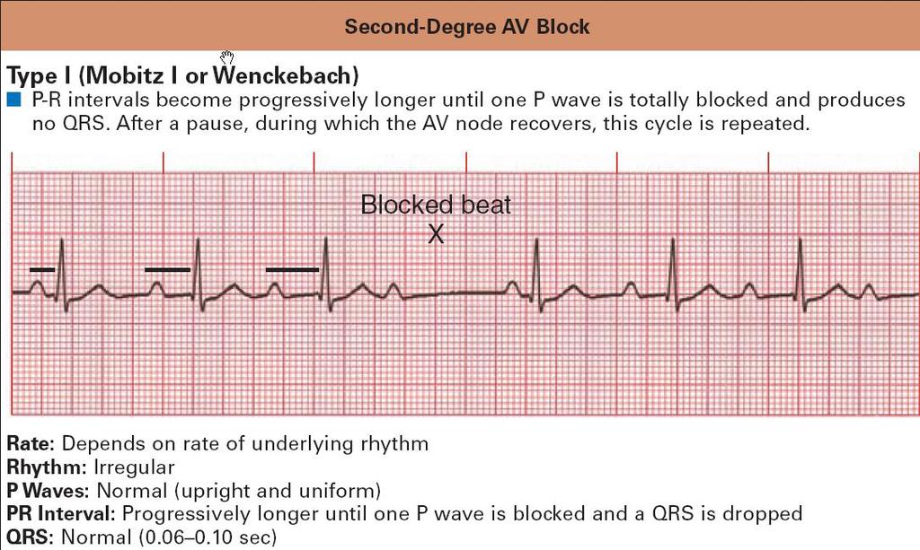 II Derece AV Blok MOBİTZ TİP 1 (WENKEBAH) Ritim