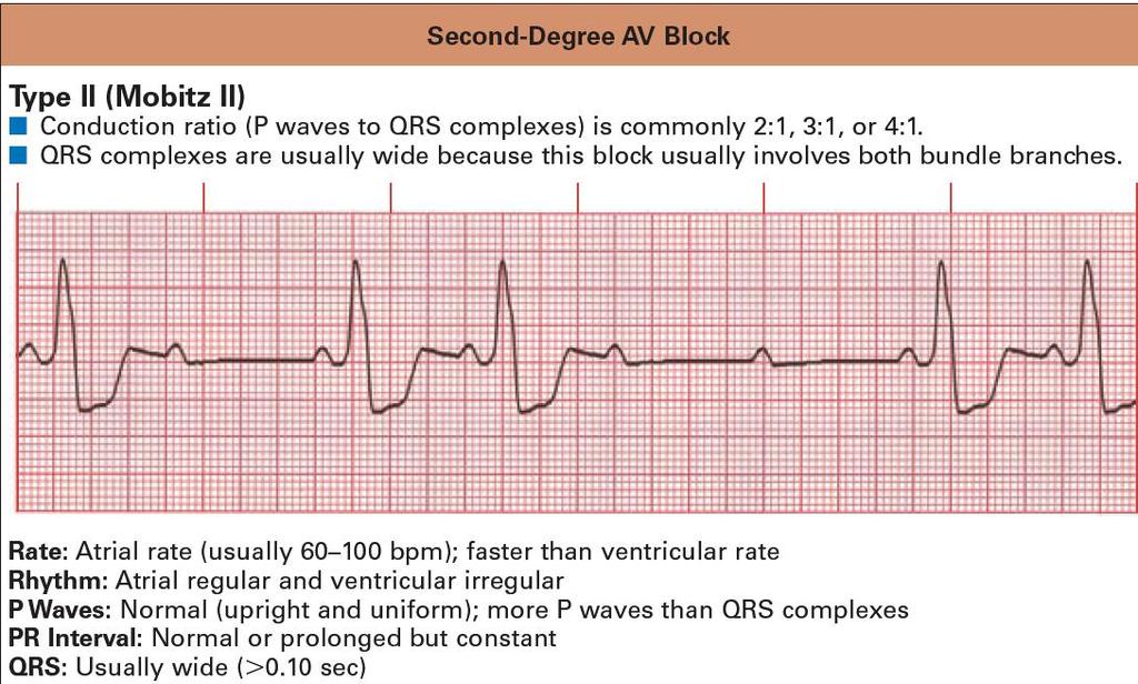 MOBİTZ TİP 2 Atriyal hız 60-100, ventrikülden daha hızlıdır.