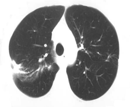 Vorikonazol ile tedavi edilen dirençli pulmoner ve serebral aspergilloz olgusu İPA genellikle hematolojik maligniteli, uzun süreli steroid veya immünsüpresif tedavi alanlarda ve AIDS li hastalarda