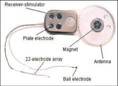 Konuşma işlemcisi: Sinyali kodlayıp amplifiye ederek, iç kulak stimulasyonu için uygun hale getirir. Elektriksel uyarı daha sonra dış antene iletilir. aktarır. 3.