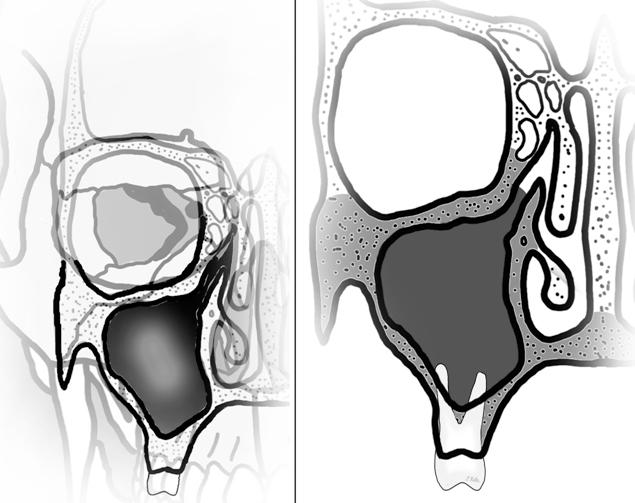 Foramen infraorbitale (göz boşluğunun altındaki delik) 17 Sinus maxillaris (üst çene kemiği içerisindeki boşluk) Sinus maxillaris;