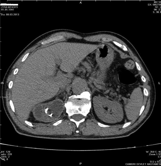 Yeni Üroloji Dergisi - The New Journal of Urology 2013; 8 (3): 66-70 Şekil II. Hidronefrotik böbrekte stentin proksimal koil yapısı Şekil III.